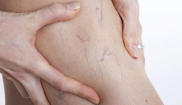 Spider Veins Are Spider Vein Treatable