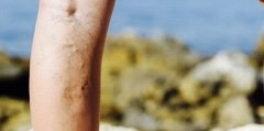 Varicose Vein