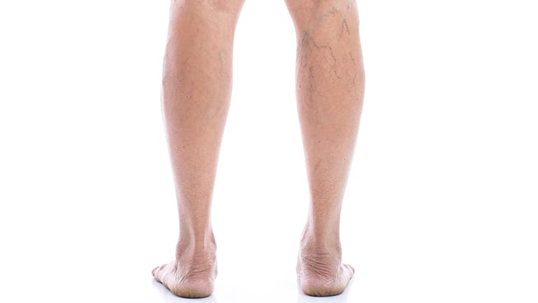 Spider veins and varicose veins are often caused by underlying vein diseases. In this article, our vein doctor discusses spider vein treatment in Houston, Texas.