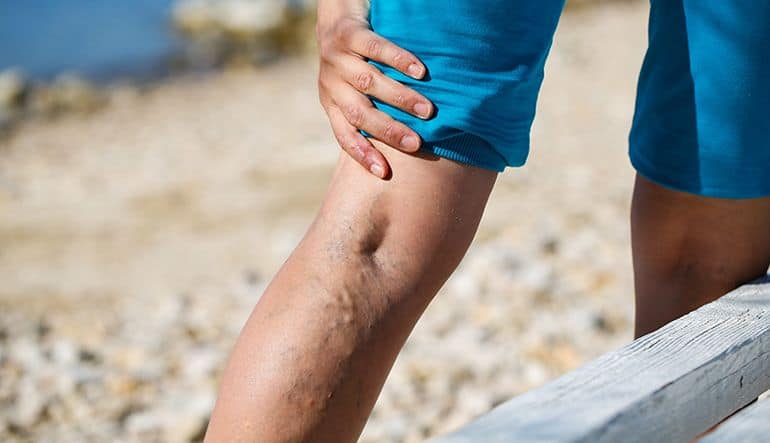 Excellence in Varicose Veins Treatment and Prevention