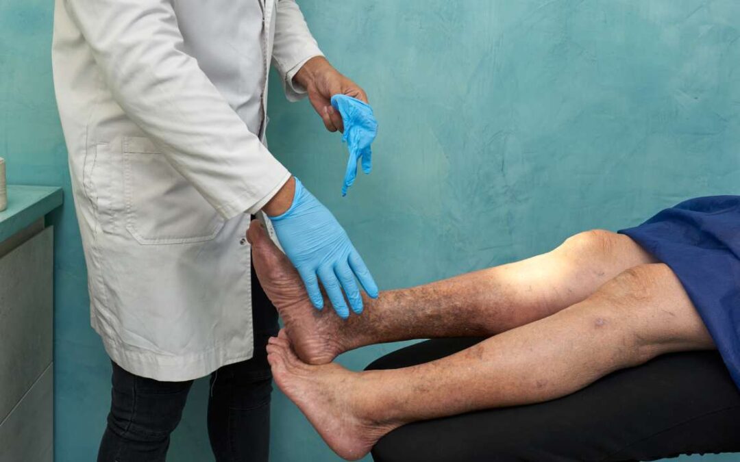 How to Prevent Varicose Veins: Tips, Causes, and Treatments