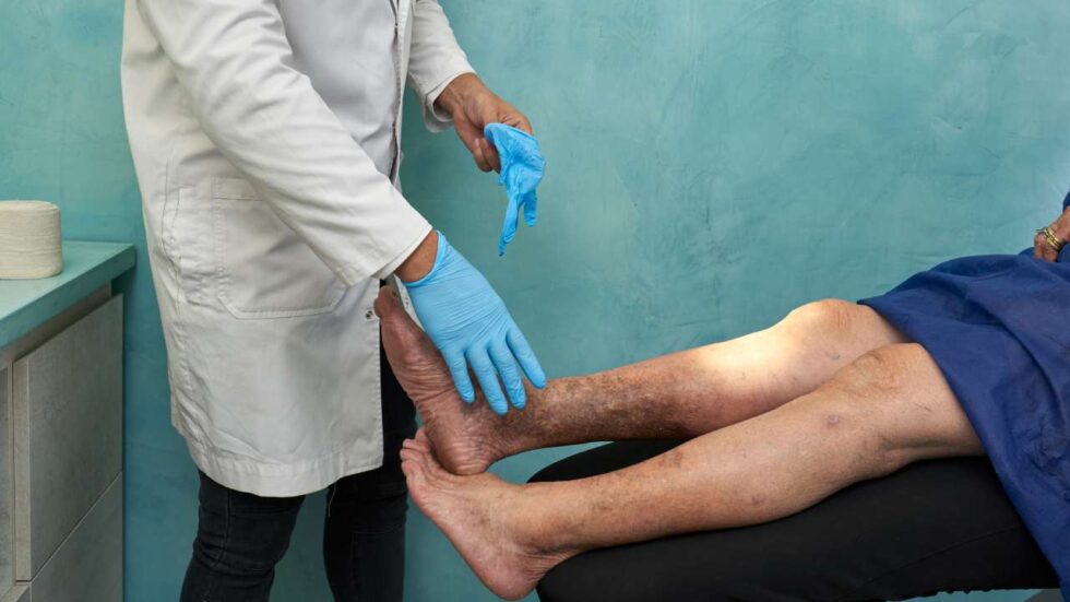 How to Prevent Varicose Veins: Tips, Causes, and Treatments
