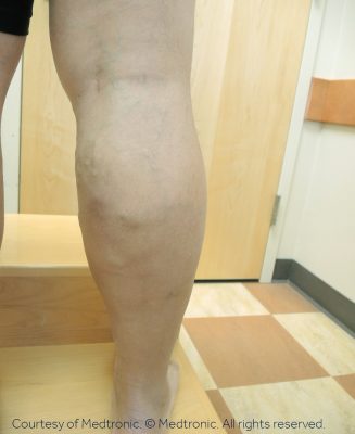 Can Venous Insufficiency Be Cured? Vein Doctor Varicose Veins on Leg