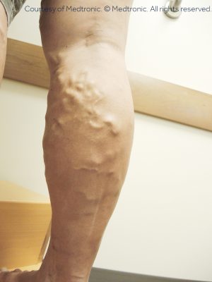 Varicose Veins and Spider Veins