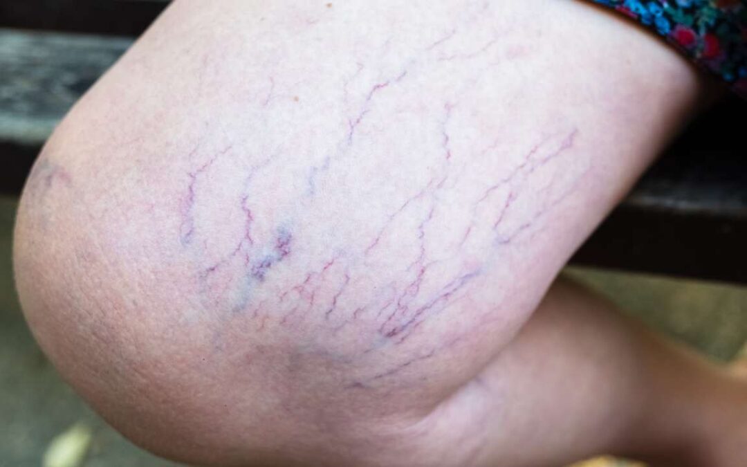 Are spider veins bad? What Are Those Marks on Your Legs?