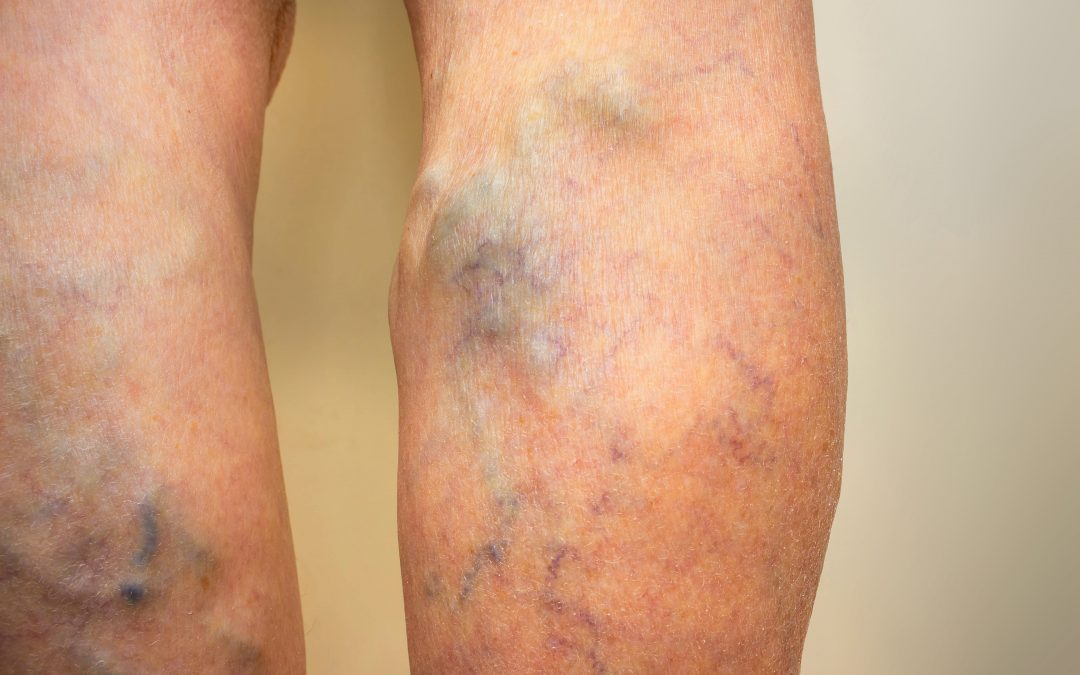 Which of the Following Best Describes Your Varicose Veins?