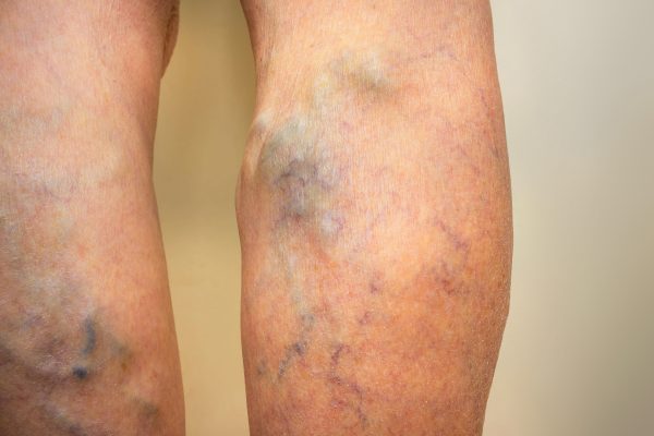 Can you see large, twisted veins on the surface of the skin? If so, you may have varicose veins. In this article, we will answer your question “can varicose veins cause pain?” and discuss some of the common symptoms and treatment options.