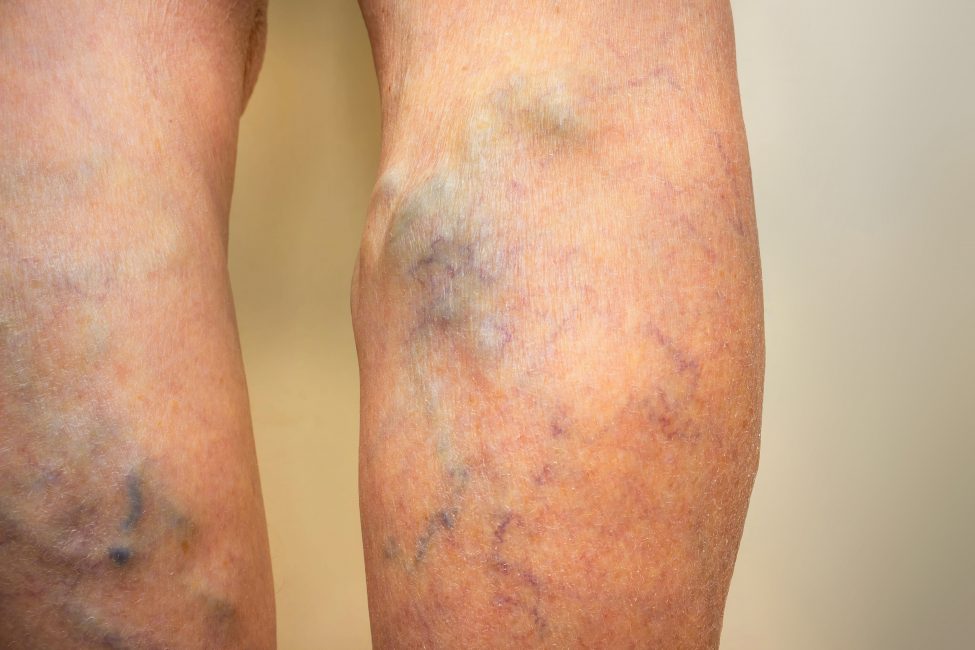 Laser Vein Ablation Treatment for Varicose Veins Advice from a VTC Expert