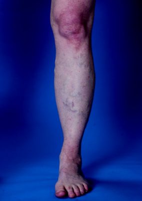 The expert vein doctors at the Vein Treatment Clinic shed light on some of the circulatory system’s biggest mysteries, including this one: If blood is red, why are veins blue?