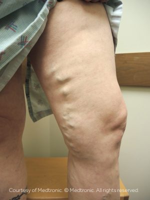 The cost of varicose veins treatment depends on whether you have symptoms. If you have pain or discomfort, insurance will usually cover the cost of the procedure.