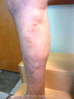 what causes varicose veins