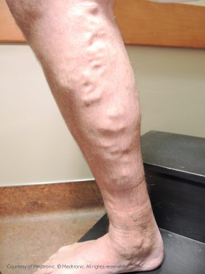 What causes varicose veins