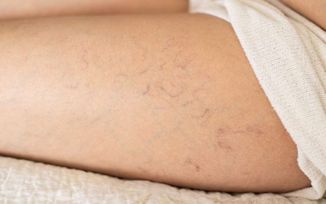 What Are Spider Veins? Learn how to prevent and treat them