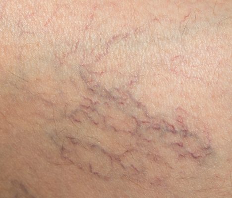 Spider Veins and Varicose Veins Need Sclerotherapy from a Vein Doctor NY or Vein Doctor NJ