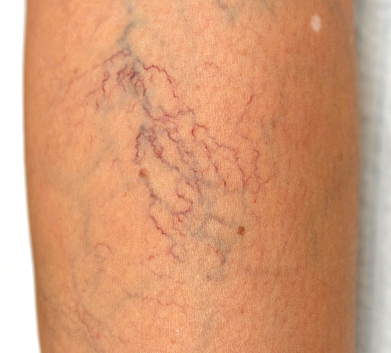 Spider Veins can be physically uncomfortable, ugly, and a warning sign of a dangerous vein problem called venous insufficiency. In this article, you will learn what spider veins are, how to get rid of spider veins, and where you can find a reliable vein treatment clinic.