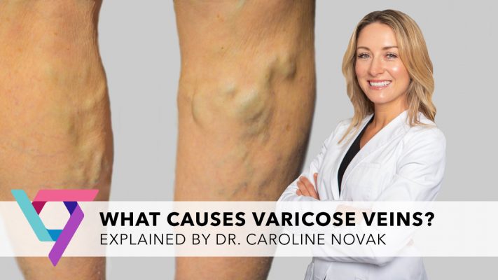 The Pros and Cons of Compression Hose for Varicose Veins