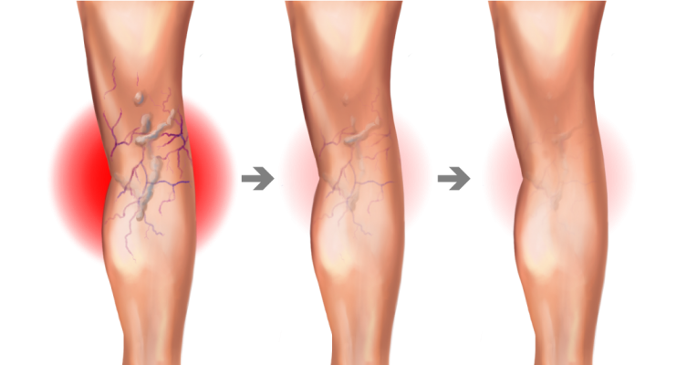 How Much Does Varicose Vein Treatment Cost? Board How Much Does Varicose Vein Treatment Cost? Board