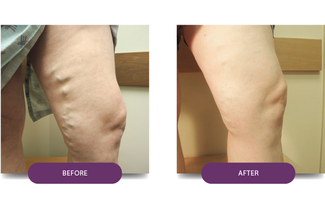 BeforeAfter1-Patient-13-After-medtronic-vein-treatment-center-VIP-medical-group