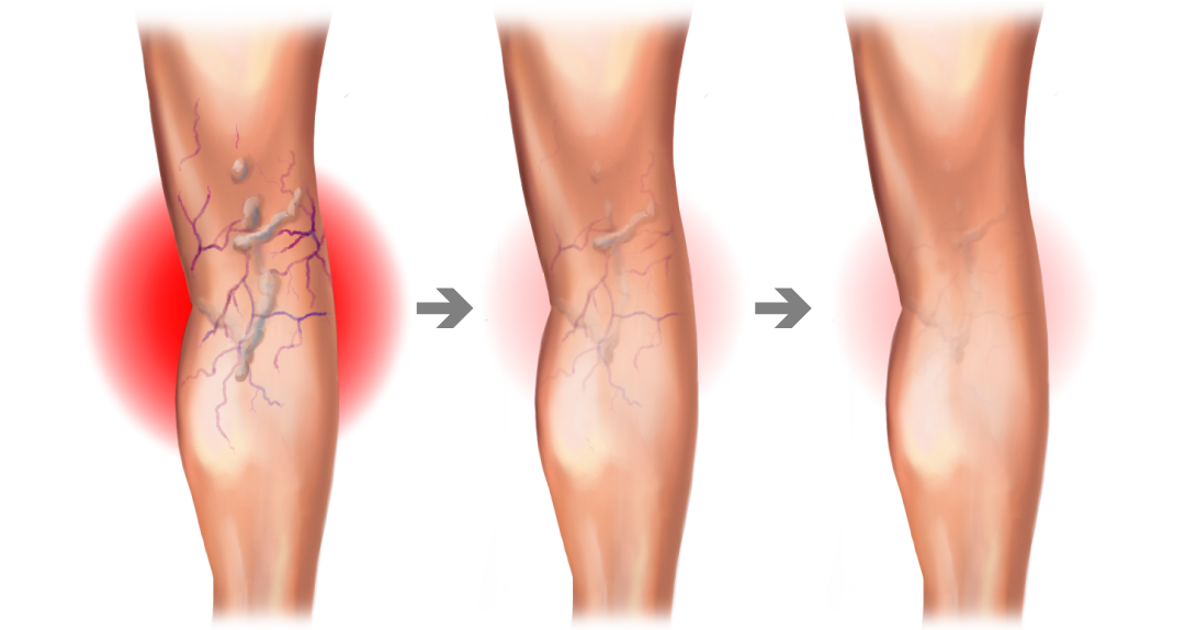 What Causes Varicose Veins Causes Prevention And Treatment