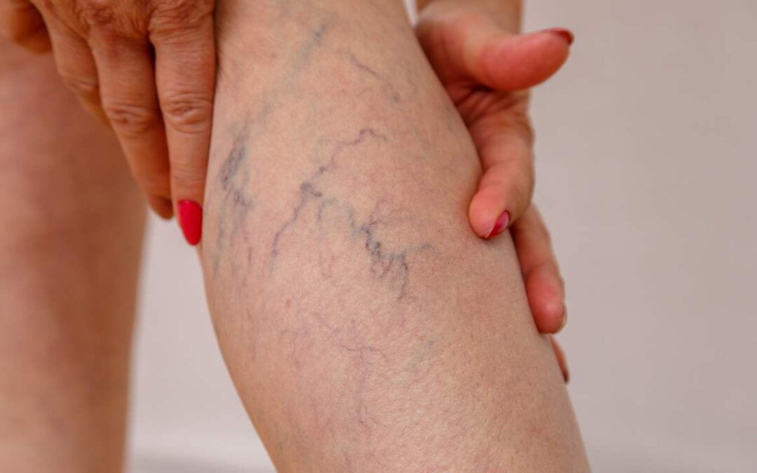 Is There a Cure for Spider Veins? Vein Specialists Q&A