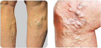 Spider veins and varicose veins originate from the same kind of faulty vein, but they have differences. Learn about how these differences affect your symptoms, and methods of treatment.