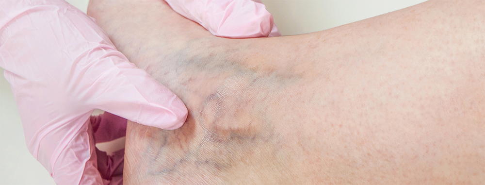 Varicose and Spider Veins | Vein Diseases