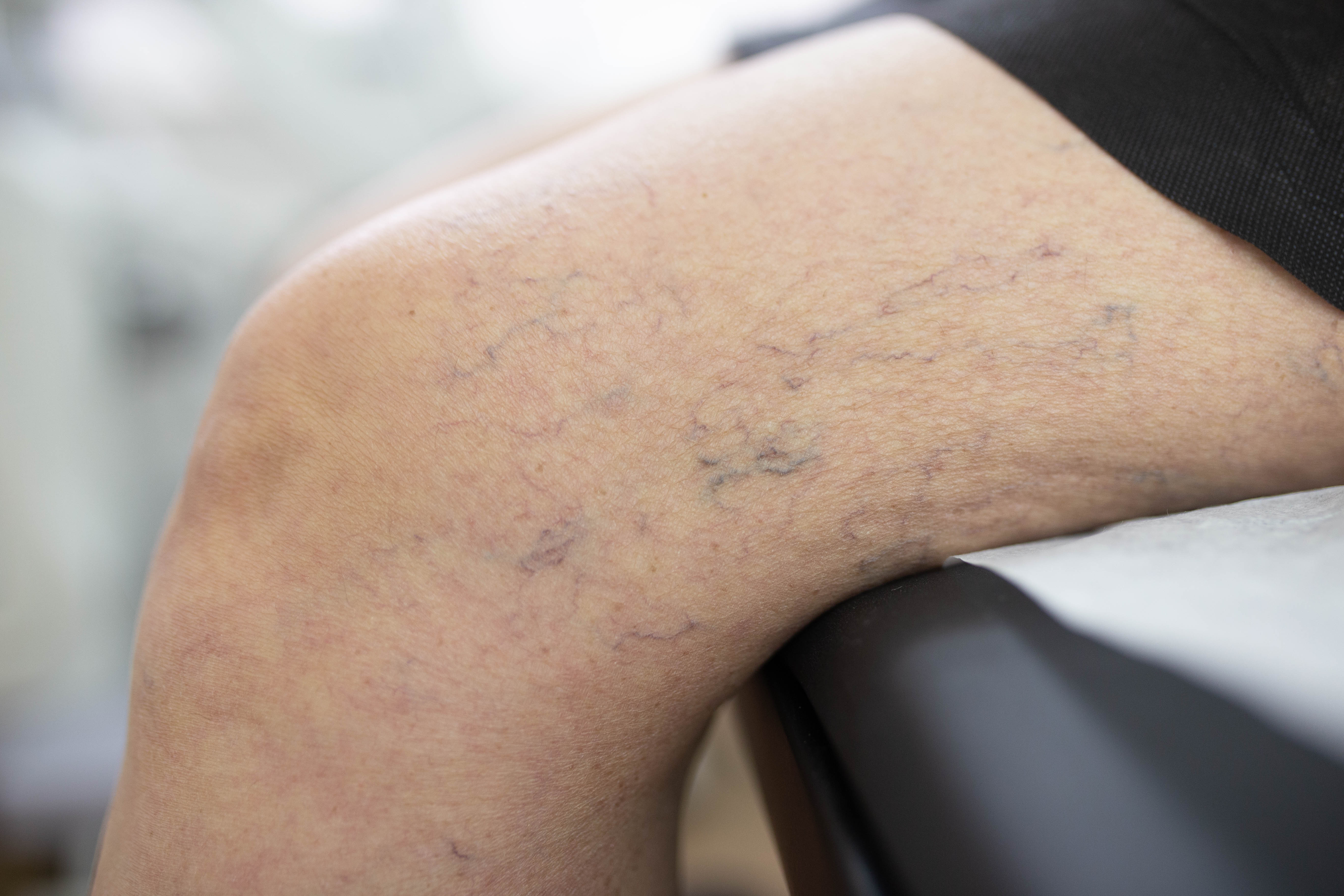 how to get rid of spider veins