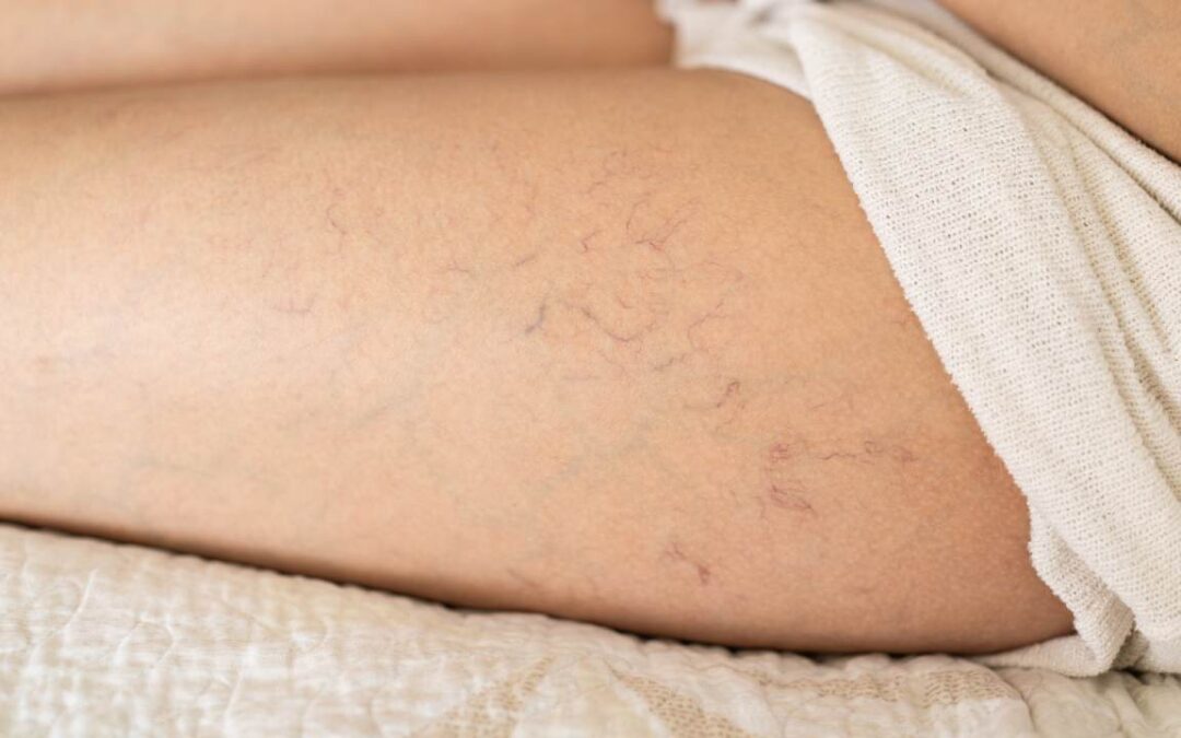 Top Ten Effective Ways to make Spider Veins Go Away!