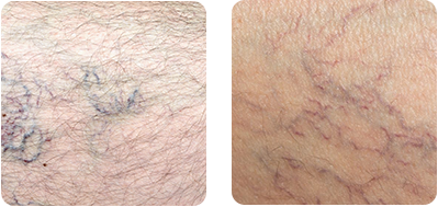 Spider veins may look alarming, but they need not be a cause for concern. We help you understand why they appear, how to prevent them, and when you need to seek treatment.