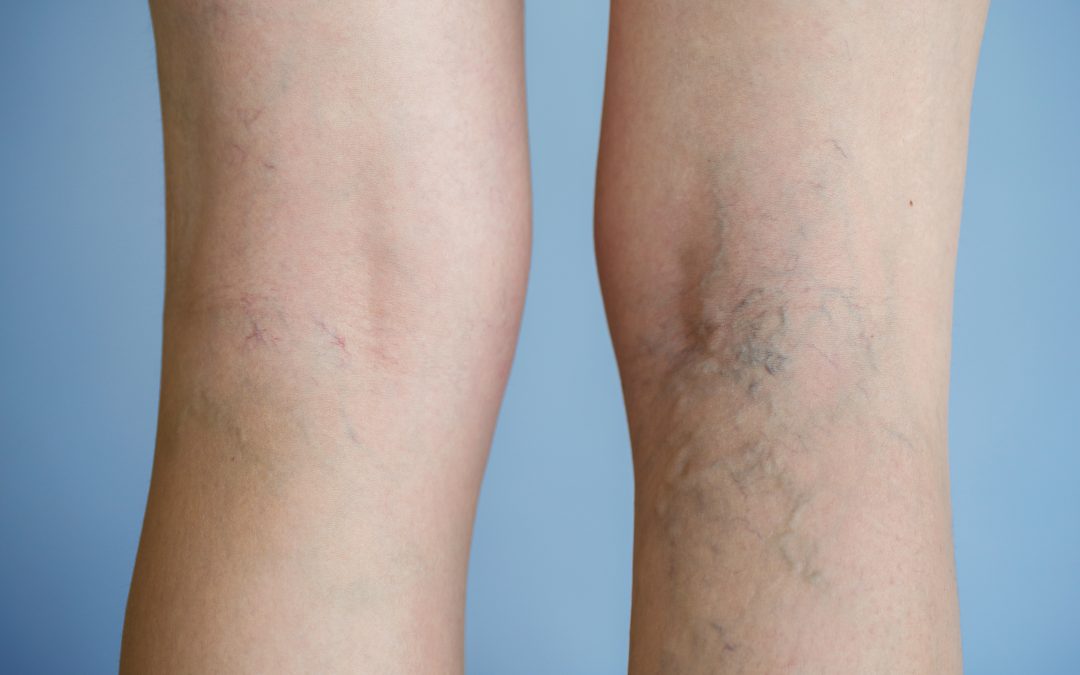 Spider Veins vs. Varicose Veins– Does it matter? | Harvard Trained Vein Doctors | Spider and Varicose Vein Treatment Center