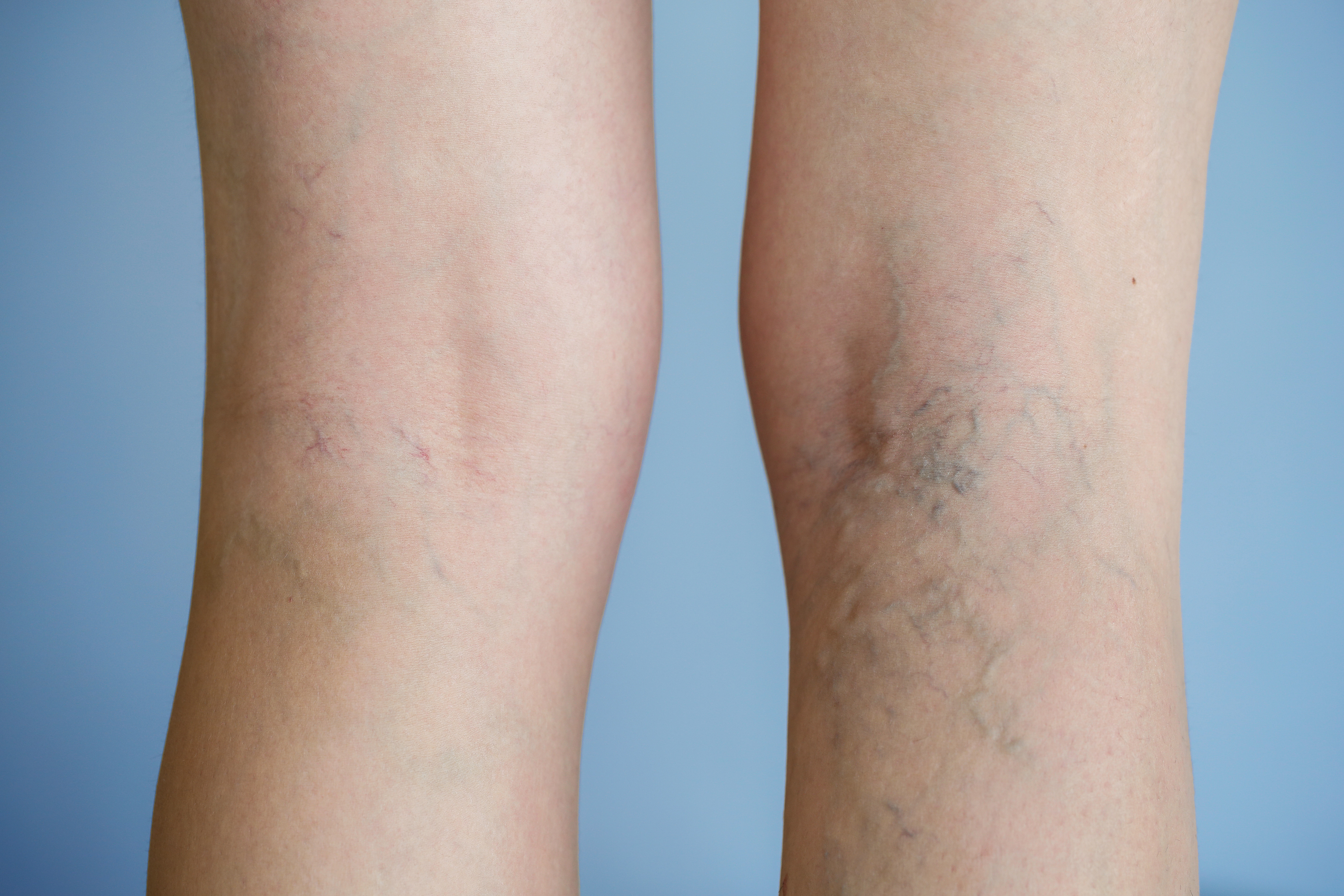 Spider Veins can be treated in several different ways; a specialized vein doctor will tailor the treatment to each individual.