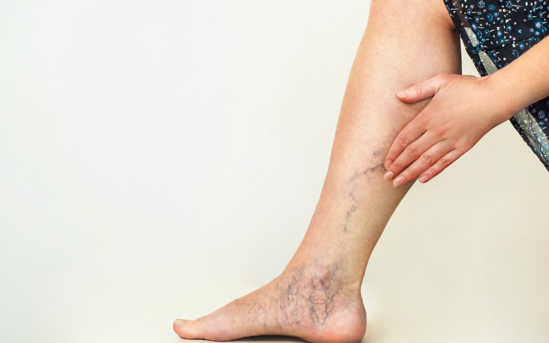 Can Venous Insufficiency Be Cured | Harvard Trained Vein Doctors | Spider and Varicose Vein Treatment Center