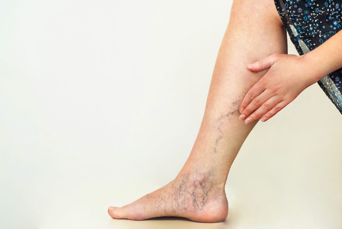 Varicose and Spider Veins | Vein Diseases