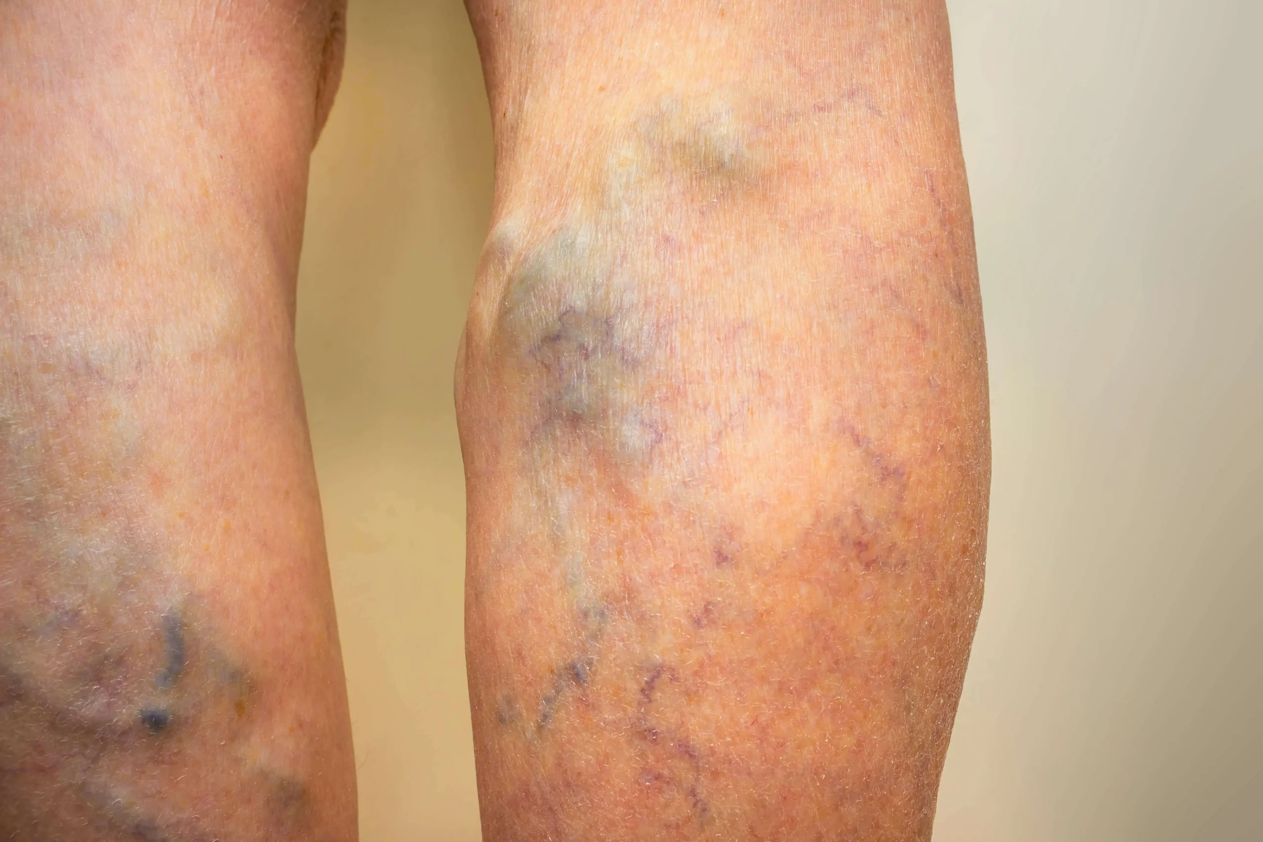 does fibroid removal affect hormones?