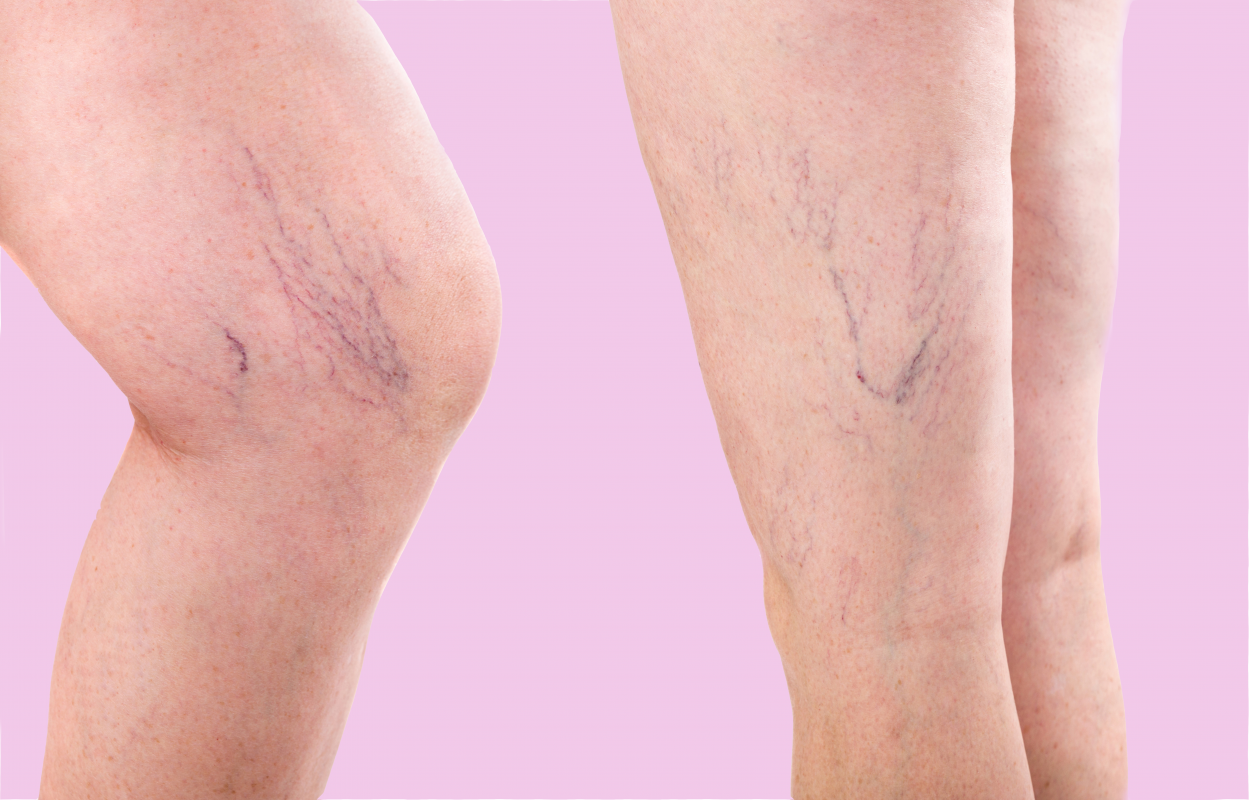 Varicose and Spider Veins | Vein Diseases