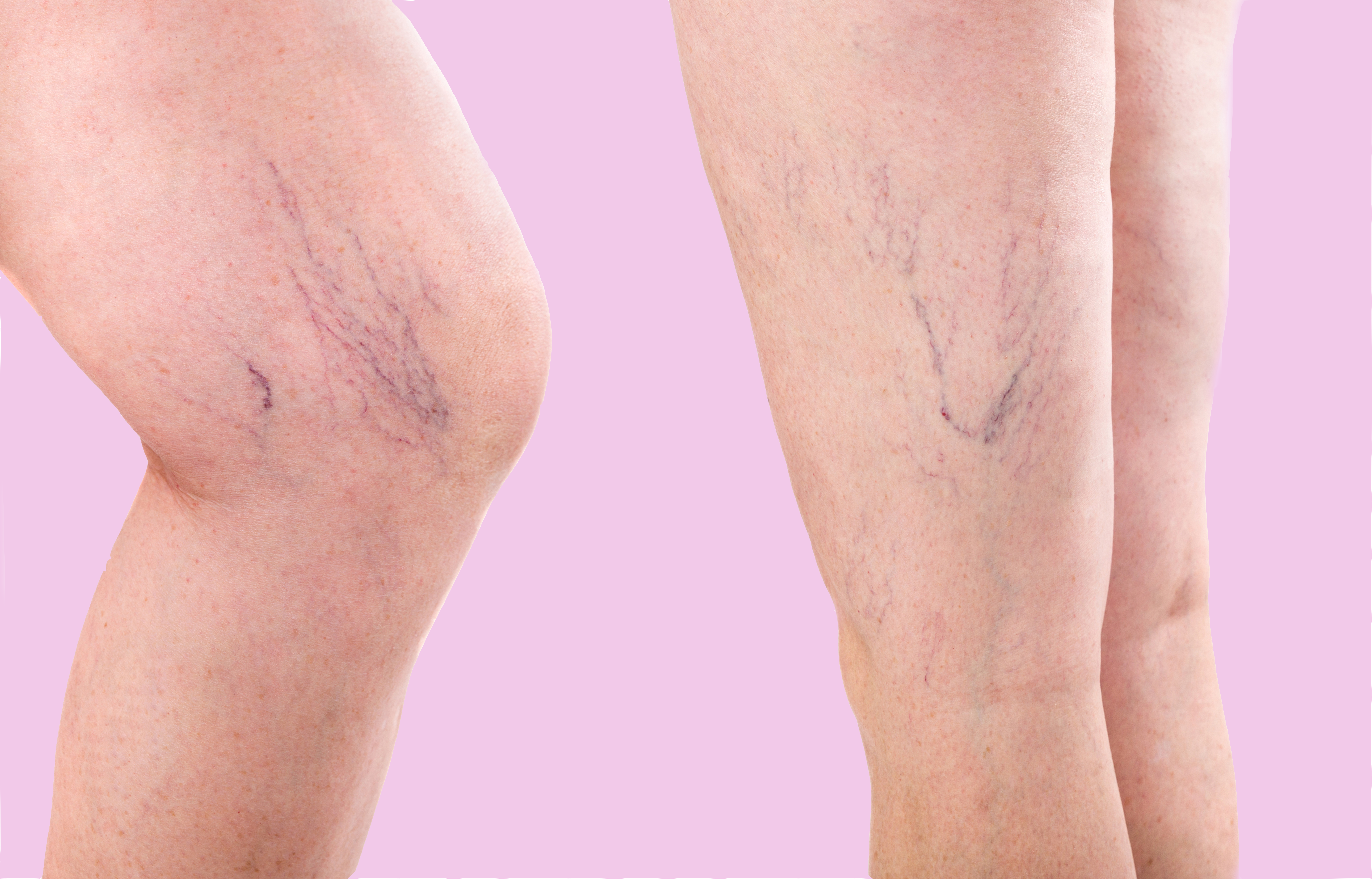 Spider veins are red clusters of blood vessels on the surface of your skin that may be caused by vein disease. In this article, we discuss the average price of spider vein treatment.