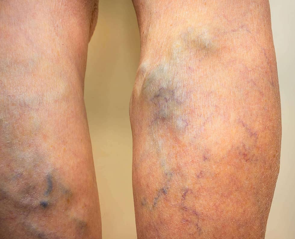 Varicose veins 