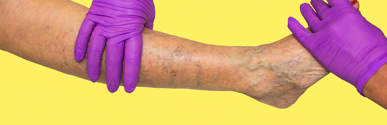 Varicose and Spider Veins | Vein Diseases