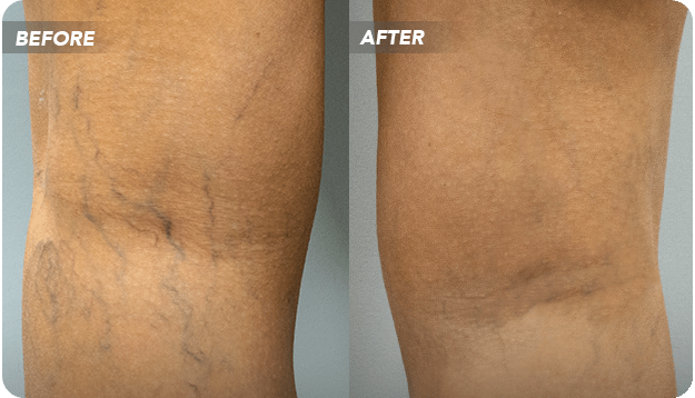 Reading laser vein treatment reviews online can be confusing, with differing opinions. Our experts take you through the procedures involved in laser vein treatment – and whether you can find other alternatives.