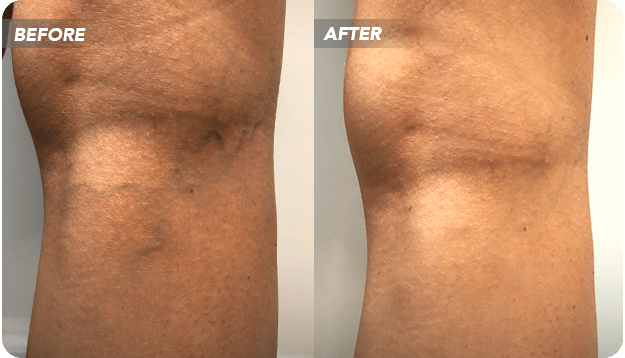 Have you been considering laser treatment for spider veins? This article will tell you why laser vein removal centers may not be the ideal option – and what you should look for instead.