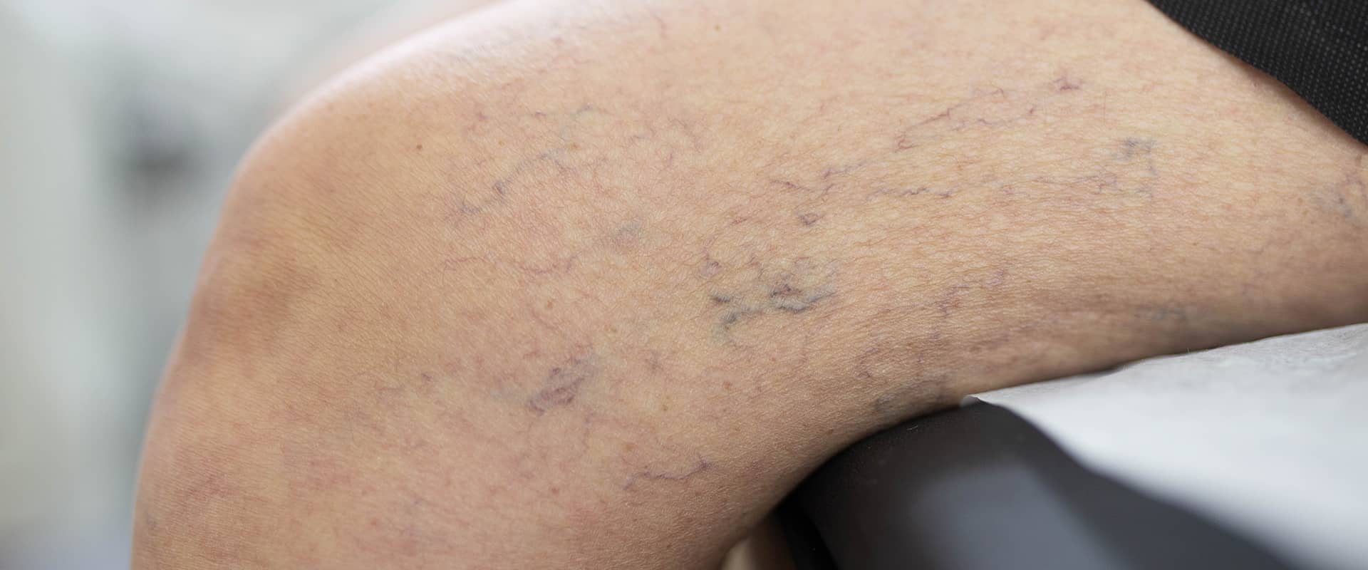 Varicose veins treatment