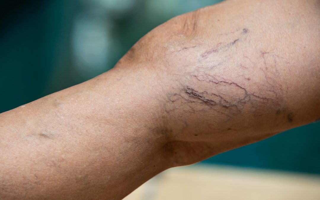 Varicose Vein Clinic FAQs