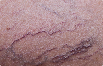 Varicose and Spider Veins | Vein Diseases