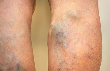Best Vein Center and Varicose Vein Doctor in New York