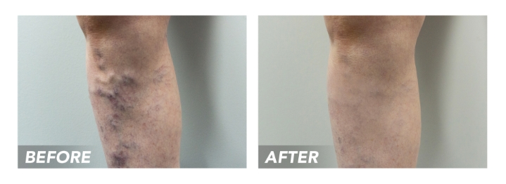 Before-After-VaricoseVeins-Patient3 (1)