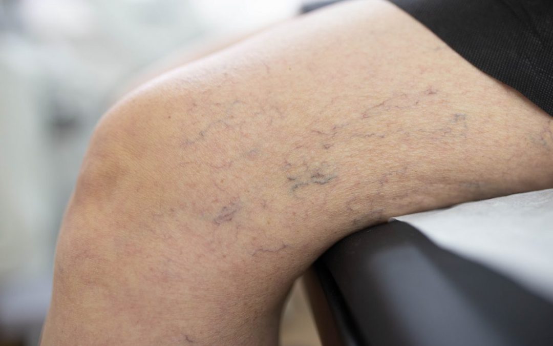 Varicose Vein Clinic in New York Describes Minimally Invasive Treatments for Varicose Veins and Spider Veins