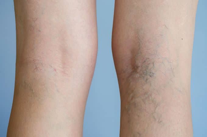 Vein Treatment Clinic Compression Stockings Sclerotherapy