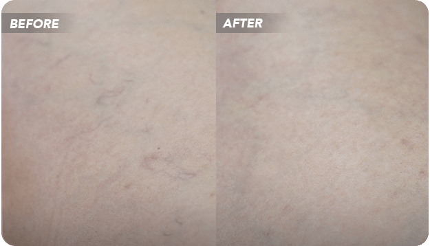 VTC-Before-After-0- VTC Before-After-0
