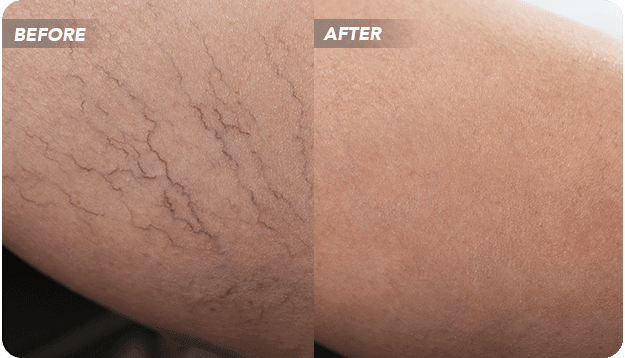 What Vein Problems Can Be Treated at a Varicose Vein Clinic in NJ? A Top Vein Doctor Lists the 5 Most Common Conditions.