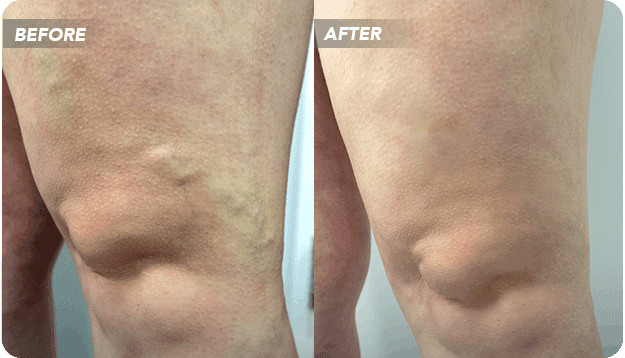 VTC-Before-After-3 Sclerotherapy Before and After